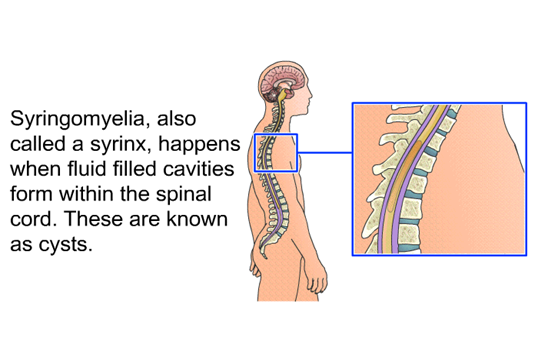 Syringomyelia illustration. Image Reprinted with permission from: X-Plain from Patient Education Institute