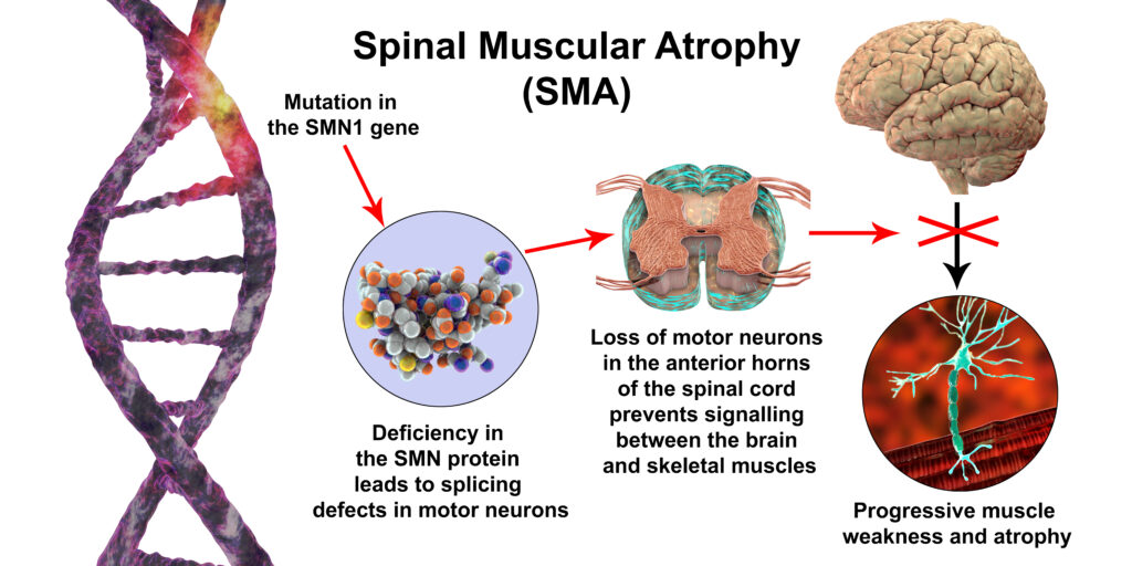 Spinal Muscular Atrophy (SMA)