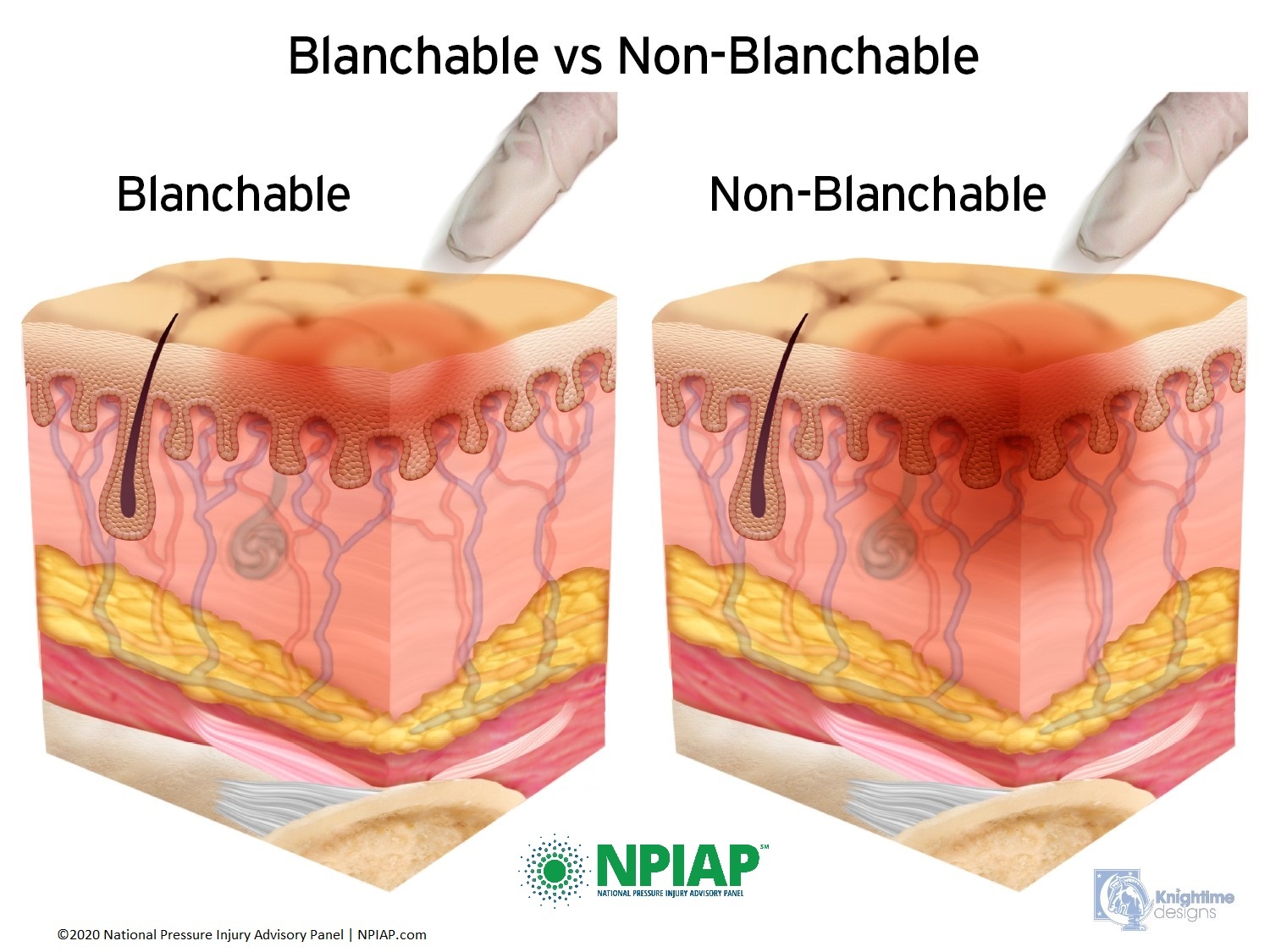Blanchable vs. Non-Blanchable