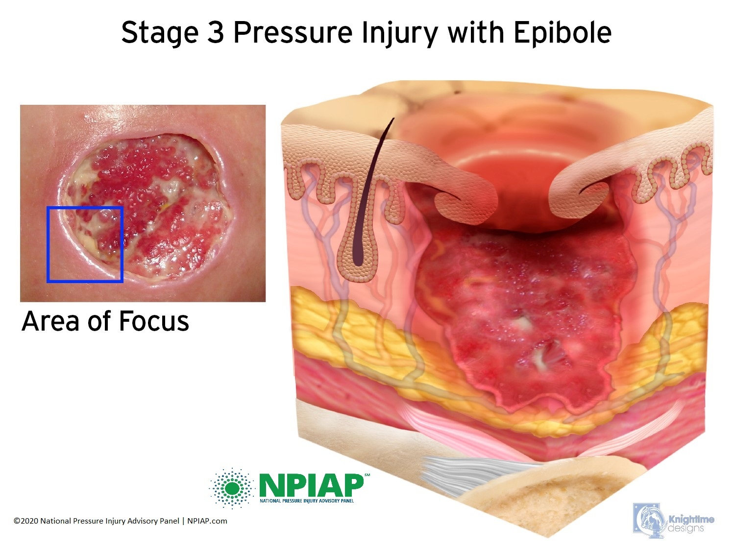 Stage 3 Pressure Injury with epibole