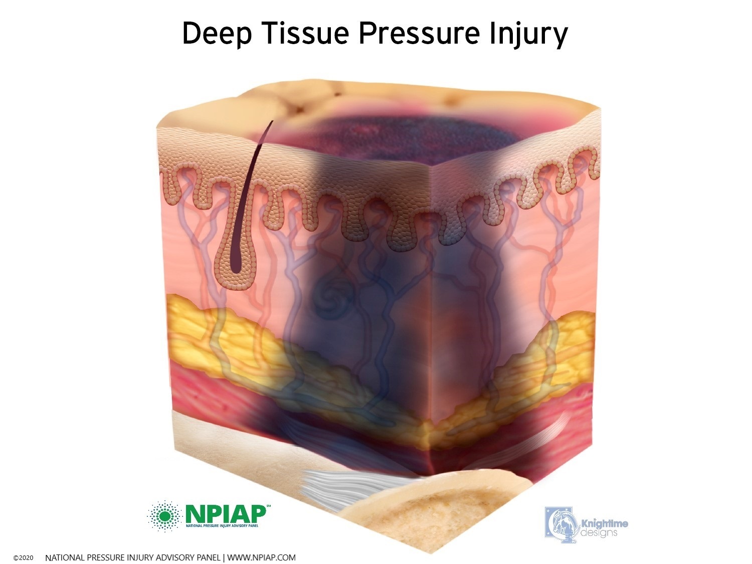 Deep Tissue Pressure Injury