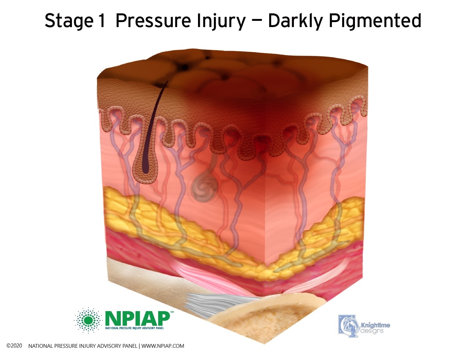 Stage 1 Pressure Injury - Darkly Pigmented