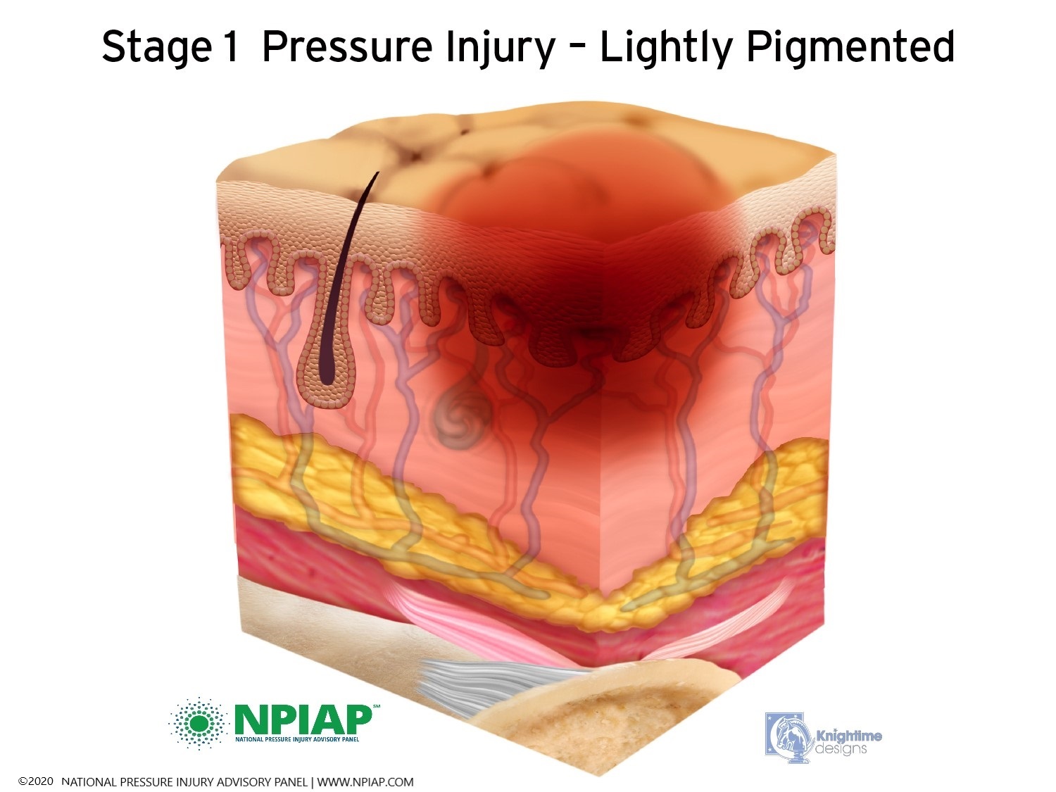 Stage 1 Pressure Injury - Lightly Pigmented