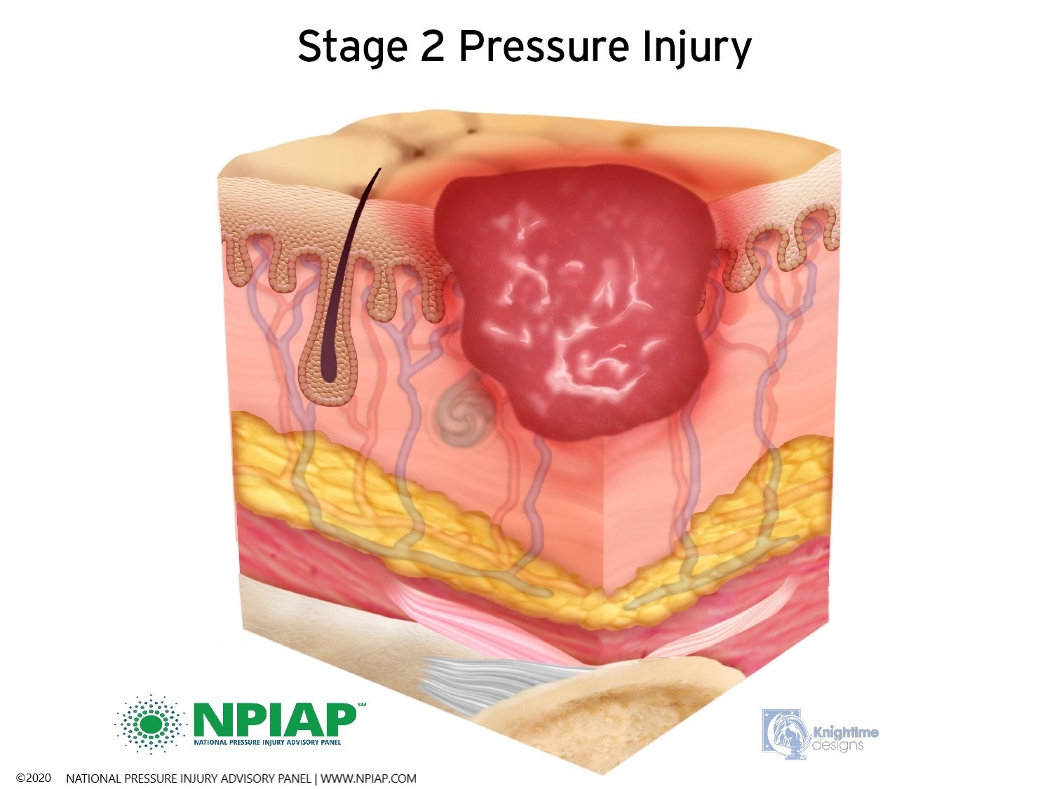 Stage 2 Pressure Injury