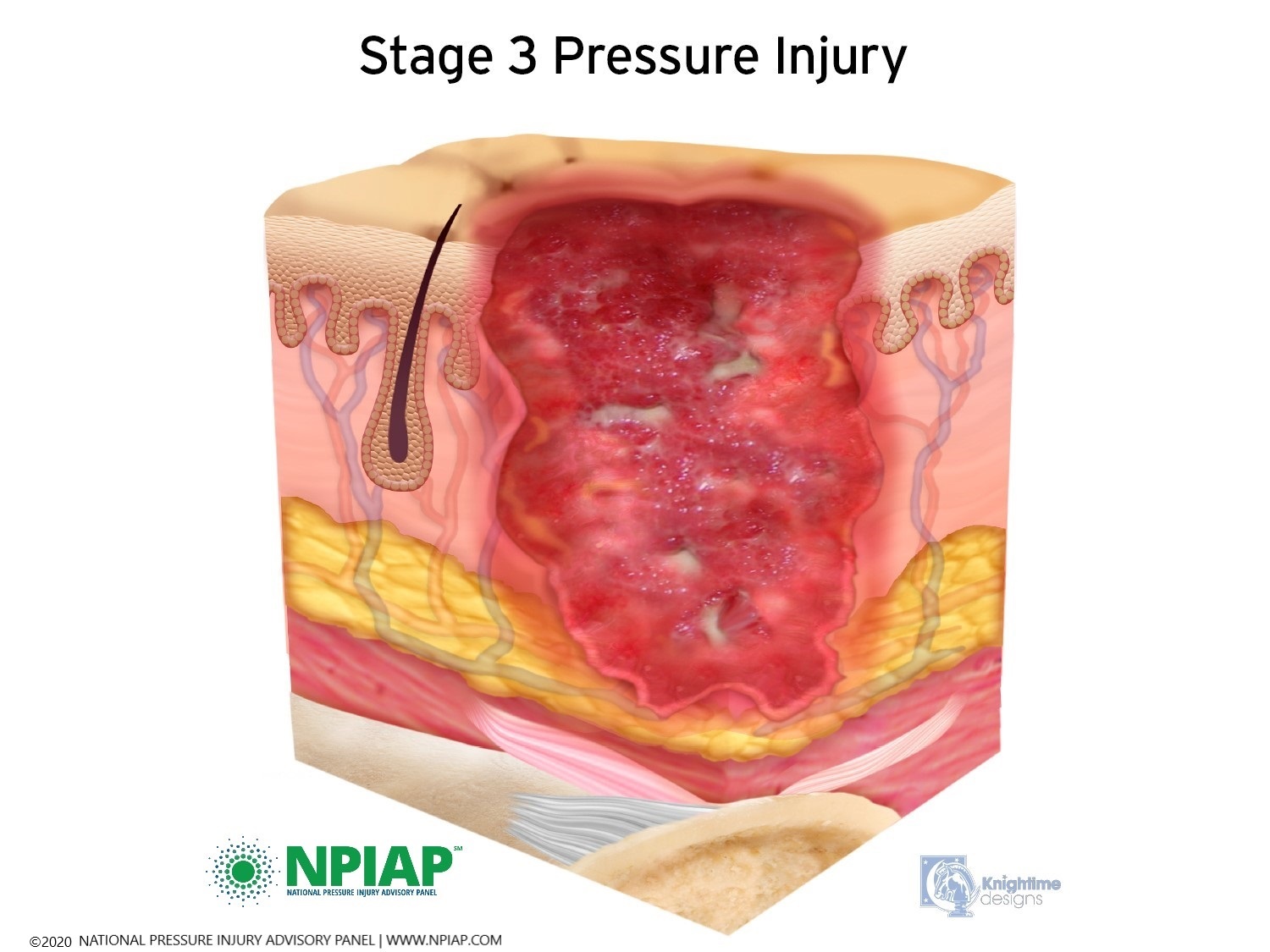 Stage 3 Pressure Injury