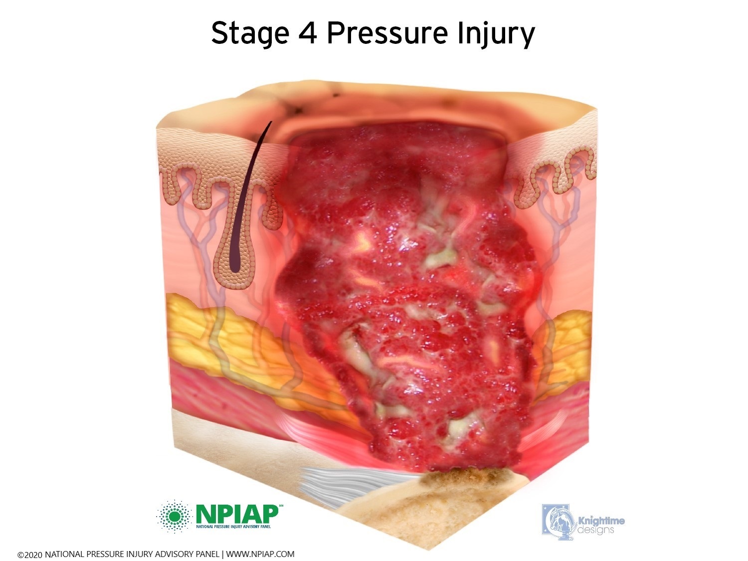 Stage 4 Pressure Injury