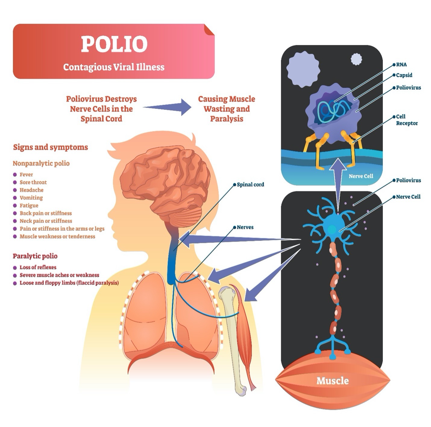 Polio Contagious Viral Illness diagram