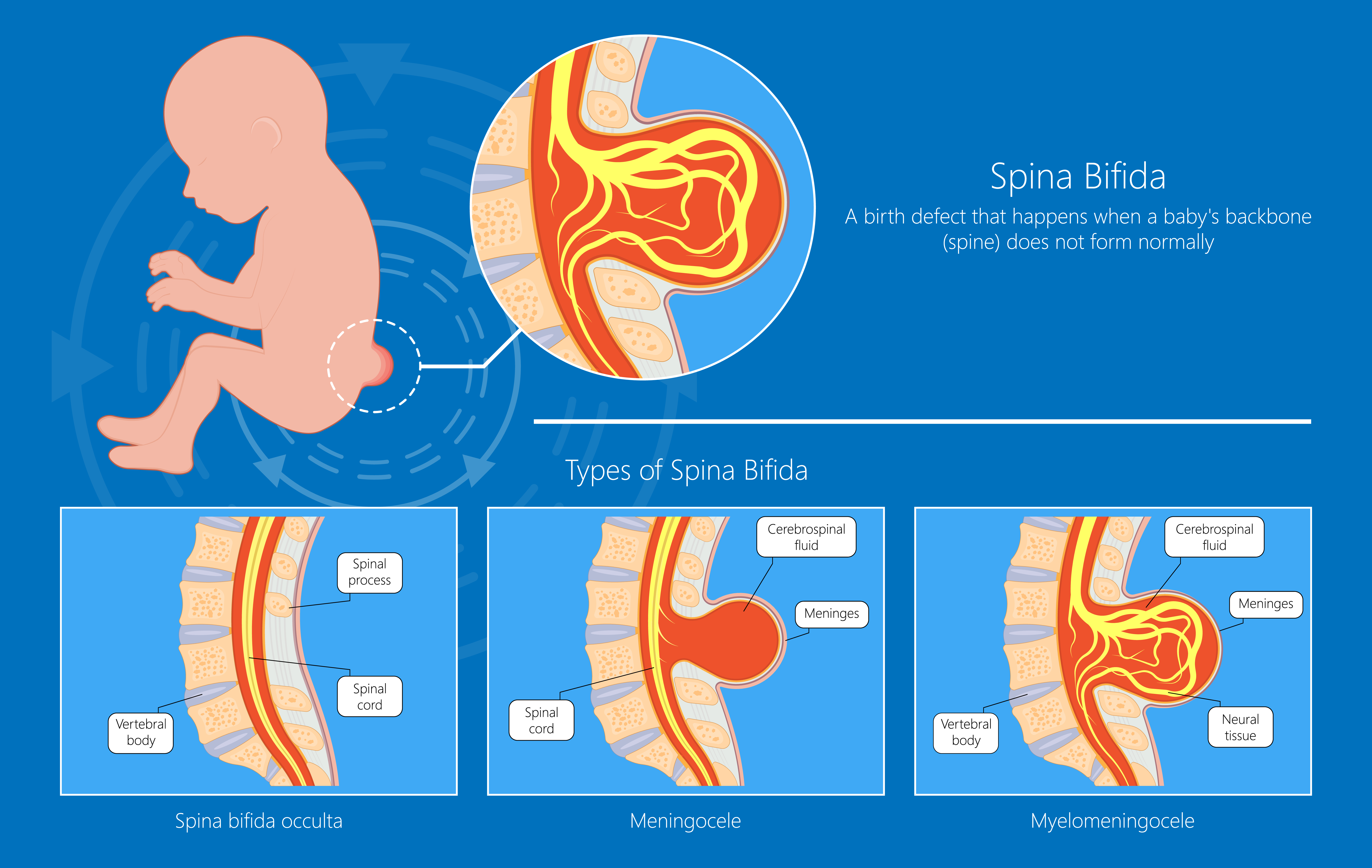 Types of Spina Bifida chart