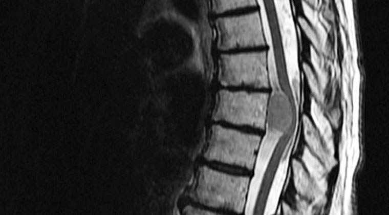 Spinal Tumor