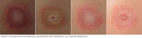 Illustration of Lyme disease rash on different skin tones. People with Lyme disease might have a ‘bull's-eye’ rash. The bull’s-eye rash gradually spreads over days.