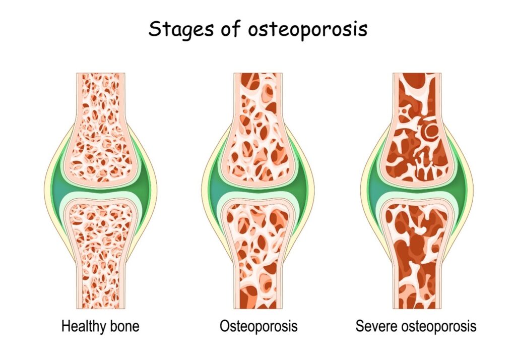 Illustration of the stages of osteoporosis